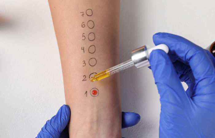 Allergy Testing Cape Town