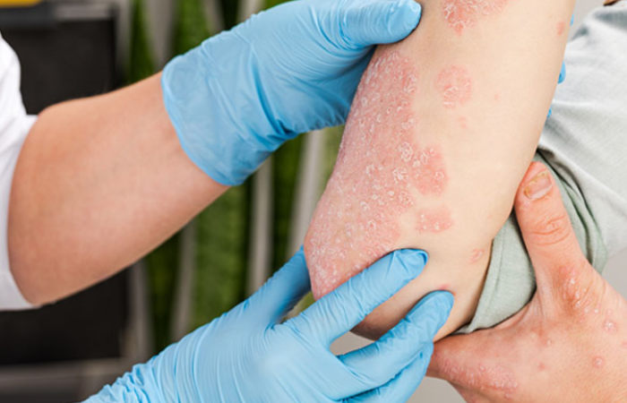 Psoriasis treatment